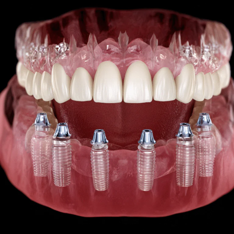 Large CBCT scan of both jaws for full-arch dental implant planning
